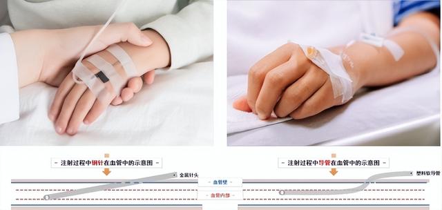 输液时打的“留置针”是什么？