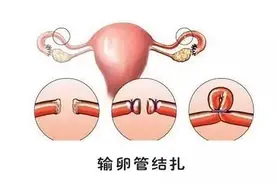 男人结扎和女人结扎，哪个伤害更大？男人结扎后会影响性能力吗？图片