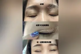 湖南姑娘眼整形失败故事：“和老公对视觉得自己很自卑，很丑陋”图片