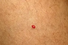 皮肤科医生和你聊聊：什么是“樱桃状血管瘤”？需要如何处理？图片