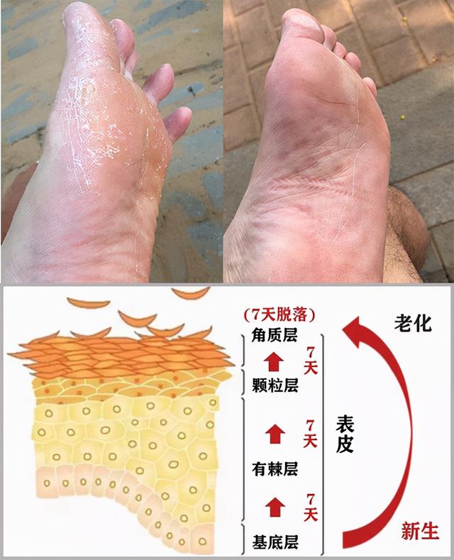 角化行脚气