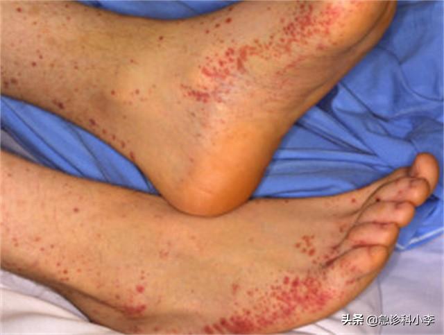 手上长了很多小红点