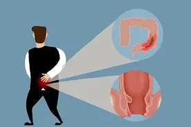 因直肠癌不得不切除肛门，会怎样？做“造口”生活上会有啥变化？图片