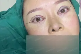 45~55岁需要做全切双眼皮手术，你需要了解的都在这里图片