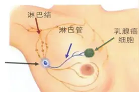 渭南市妇幼保健院：乳腺前哨淋巴结活检——保护女性健康的新选择图片