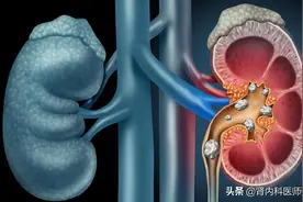 有肾结石不能吃鸡蛋？医生：肾结石真正拒绝的是这3种食物图片