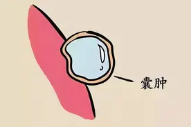 医生提醒：大多数囊肿无需处理，但若囊肿出现在5个地方，要重视图片