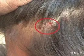 毛囊炎、出粉刺、长痘痘？分享一个方子，清热解毒，利湿消肿图片