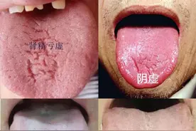 阳虚、精虚、阴虚、血虚都会裂纹舌，怎么说？看看这里就知道了图片