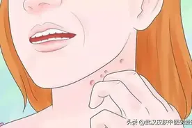 脖子上起了红肿还有小白点疼痒怎么办图片