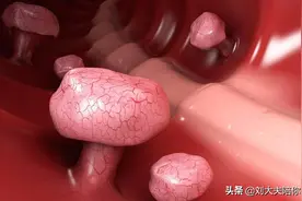 结节、息肉、囊肿？多半是痰瘀互结，送你两味药，健脾化瘀图片