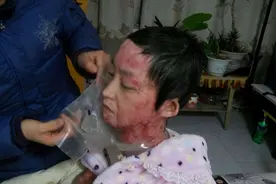 16岁女孩拒绝官二代追求，被泼汽油容貌尽毁，后来她过得如何了？图片