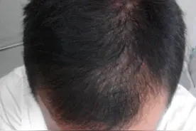 米诺地尔使用十年是什么样的经历？很难想象图片