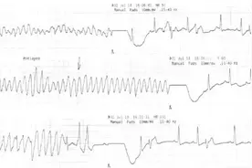 室性心动过速的诊断标准和4种鉴别方法图片