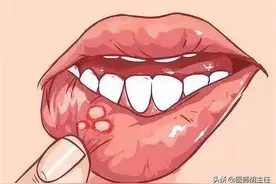 有一种剧痛叫“口腔溃疡”：只补充维生素不管用，这几种药更靠谱图片