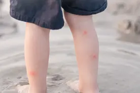 孩子突然腿疼、跛行，可能是患了这个病，家长要注意图片