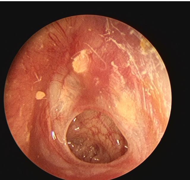 中耳炎鼓膜穿孔手术,需要多少钱