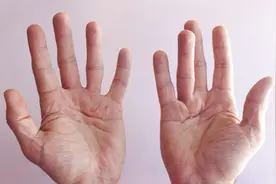 手指弯曲难以伸直，除了扳机指，还有一种病相似，搞错就麻烦了图片