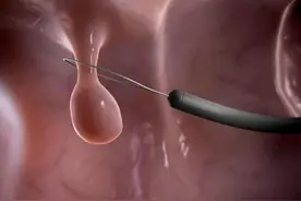 肠息肉毫无征兆？上厕所若有4个症状，建议做好检查图片