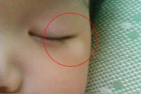 别让孩子的白斑在你的犹豫中变大！儿童白癜风，做好2点快速祛白图片