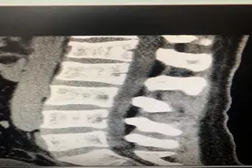 运动不当易伤身：26岁小伙，公开腰椎骨折的经历图片