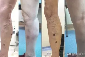 别慌，大隐静脉曲张还能这么治图片
