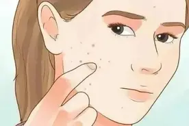 例假长痘试试这个方法图片