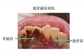 什么是牙石（或牙结石）？图片