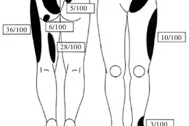 骶髂关节痛：一类容易被忽视的腰腿痛病因图片