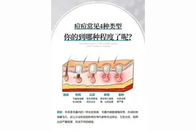 常见的四种痘痘类型，看看你是哪一种图片