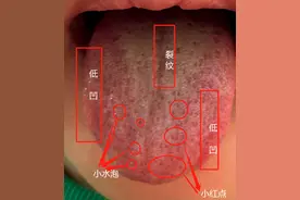 三阳已经开始了，发烧喉咙痛的，看看中医怎么辨证~图片