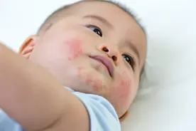 孩子吃完某种食物后，口周泛红是过敏了吗？怎么预防图片