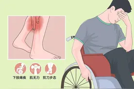 1分钟了解遗传性痉挛性截瘫图片