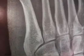 第五跖骨基底部骨折记录感受2月27日第一天图片