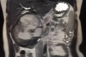 心慌、胸闷 当心“青睐”年轻女性的胰腺肿瘤图片