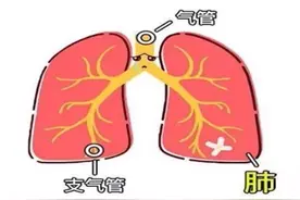 支气管炎常用的三种药物，大家可以根据自己症状选择！图片
