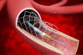 冠心病患者什么情况下需要植入支架？支架能管多少年？图片