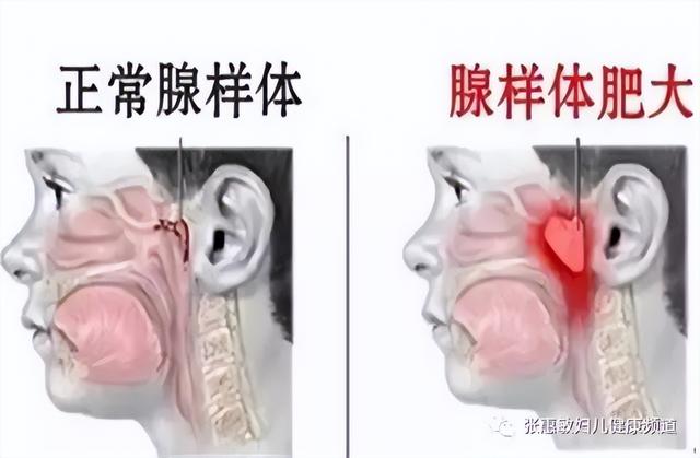腺样体一定要切除吗？这是一个有用的器官，切前需谨慎