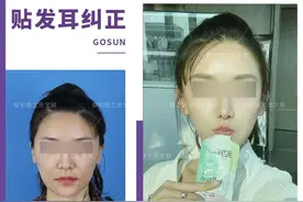 贴发耳矫正取出假体后耳朵会变形吗？图片