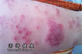 腿上皮肤红长丘疹状的水泡晚上特别痒是什么病图片