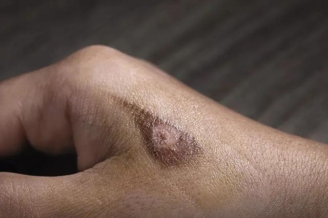 鍙椾激鍚庤杩欎箞鍋氾紝鎵嶈兘閬垮厤鑹茬礌娌夌潃