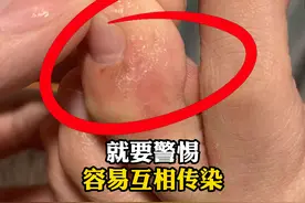 如果发现家人脚上有这种症状，当心会传染自己！#阿莫罗芬图片