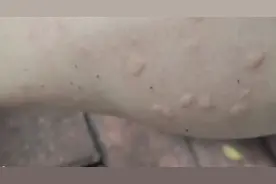 被咬后奇痒无比！这种虫子咬人比蚊子猛，3招能治它→图片