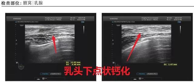 联合检查,让乳腺导管原位癌无处可逃
