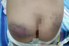山西一中学老师体罚学生，当众脱裤子用木棍抽屁股，全身多处受伤图片