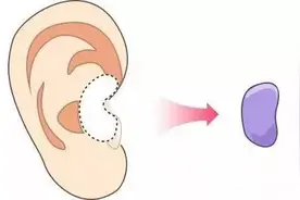 耳软骨和肋骨隆鼻主要有什么区别图片