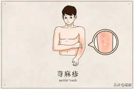 荨麻疹｜来去匆匆，奇痒难忍的荨麻疹，如何止痒，中医来支招图片