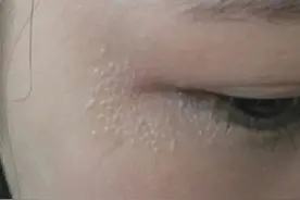 眼睛周围经常出现的这种东西，千万别大意图片