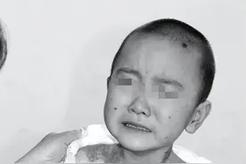 2010年河北行唐，儿子患病身长“巨型黑痣”，母亲为救子割皮移植图片