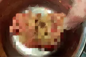 婆婆腹腔存纱布，女子怀疑系20年前阑尾炎手术医院遗留，涉事医院：对方未提交证据图片